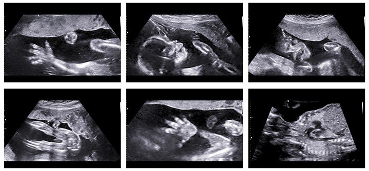 ANOMALY SCAN (Level 2 Scan) (18 to 21 Weeks) 
